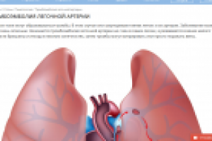 Тромбоэмболия легочной артерии