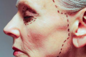 Ритидэктомия - круговая подтяжка кожи лица и шеи