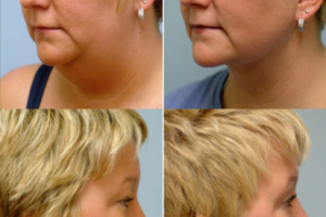 Современные методики подтяжки второго подбородка