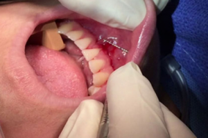 Вестибулопластика