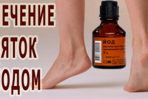 О лечении пяточной шпоры йодом