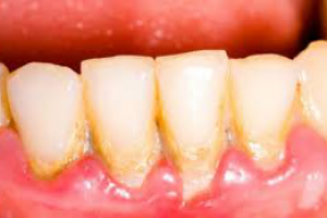 Зубной налет