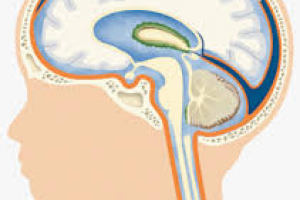 Лечение гидроцефалии в Германии
