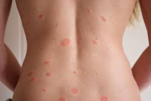 Розовый лишай