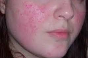 Розовые угри