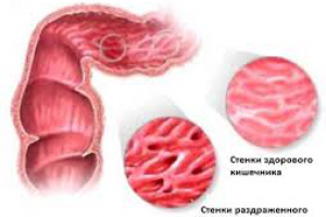 Синдром раздраженного кишечника