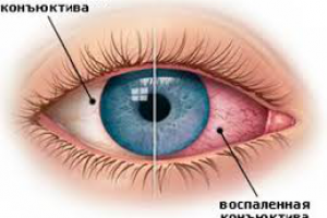 Синдром «сухого глаза»