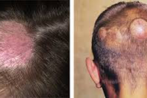 Стригущий лишай