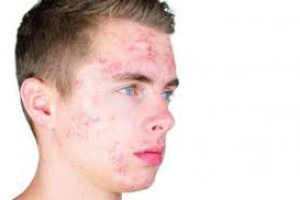 Юношеские угри