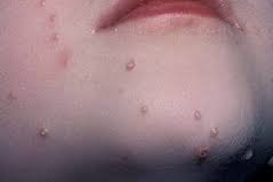 Контагиозный моллюск