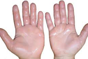 Гипергидроз