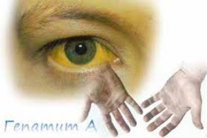 Гепатит А