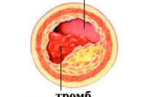 Тромбоэмболия