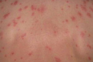 Брюшной тиф