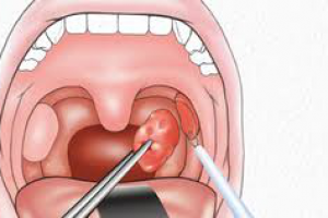 Удаление миндалин