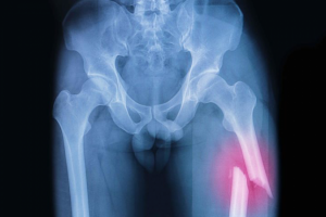 Переломы бедренной кости