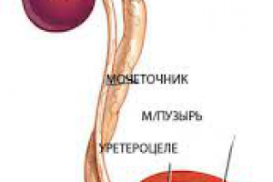 Уретероцеле