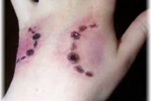 Укусы животных