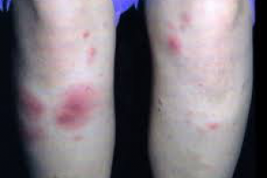 Узловая эритема