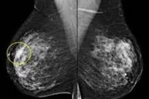 Узловая мастопатия