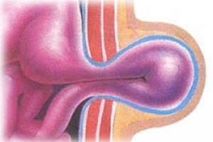 Ущемление рыжи