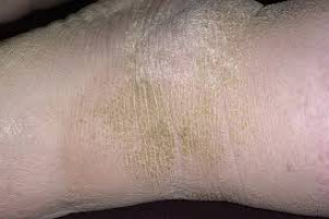 Гиперкератоз