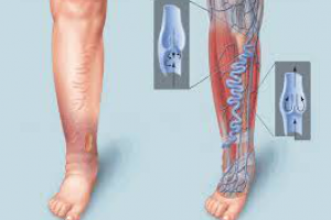 Венозная недостаточность