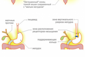Инфографика для сайта абдоминальной хирургии.