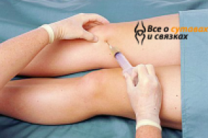 Жидкость в коленном суставе