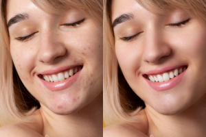 Девушка с акне - До|После