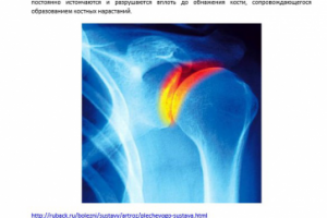 Артроз плечевого сустава