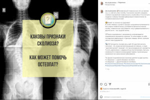 Признаки сколиоза.