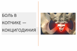 БОЛЬ В КОПЧИКЕ — КОКЦИГОДИНИЯ