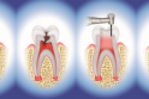 Иллюстрации лечения зубов