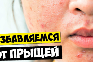 Как навсегда избавиться от прыщей?