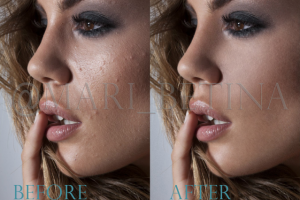 Удаление дефектов с кожи