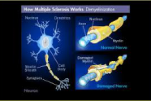 Рассеянный склероз – не приговор!