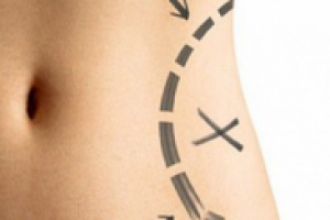 Хирургия ожирения и липосакция