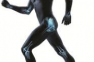 Экзостоз. Симптомы. Диагностика. Лечение