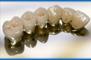 Медицина (зубные коронки из металлокерамики)