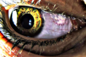 eye