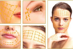 Имплантация золотых нитей