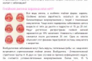 Гнойная ангина