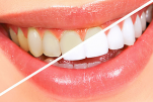 Продающий текст "Отбеливание зубов"