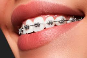 Установка брекетов