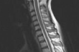 Перевод заключения по результатам МРТ позвоночника (RU>DE)