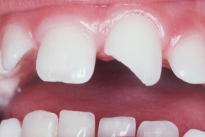 Травмы зубов: классификация, симптомы и методы лечения