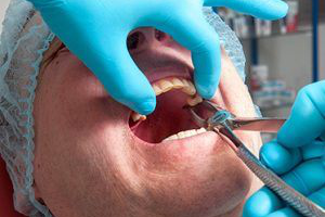 Перфорация гайморовой пазухи: причины и способы лечения