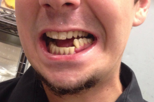 Лечение и классификация переломов челюстей