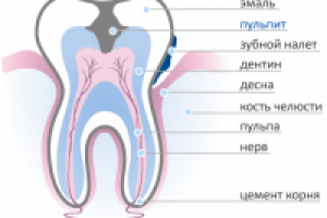 «Хронический пульпит»